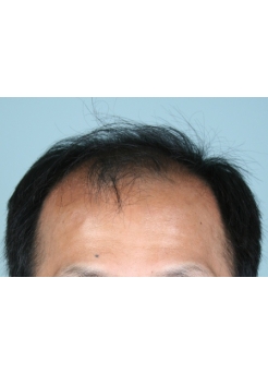 Before Hair Transplant&nbsp;2 Sessions (Areas)